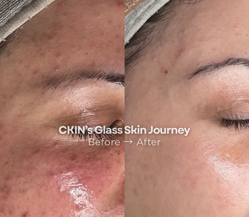 CKIN Glass Skin Journey before and after facial rejuvenation treatment results South Yarra Melbourne